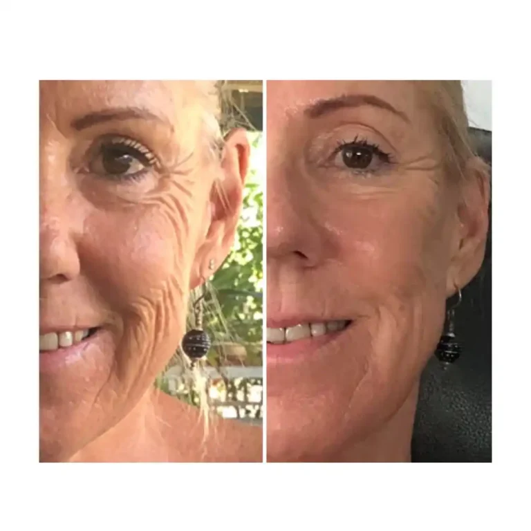 before and after pictures