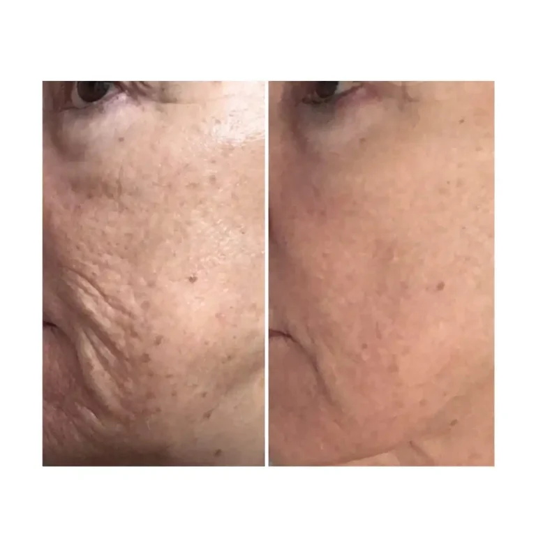 Before and after pictures