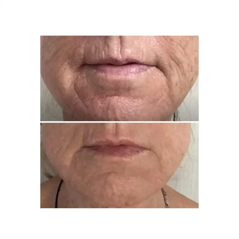 before and after pictures
